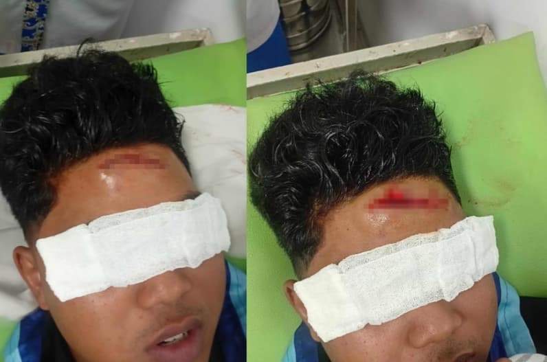 Kader PMII jadi korban saat melakukan aksi demo depan kantor Gubernur Kaltim mengalami 10 jahitan di dahi. (Foto: Herdi/Pusaranmedia.com)