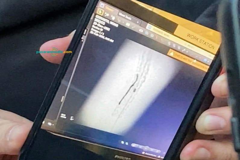 Hasil rontgen yang menunjukkan kawat yang tertinggal di jantung pasien usai operasi pemasangan ring jantung di RSUD AWS. (Foto: Tri/Pusaranmedia.com)