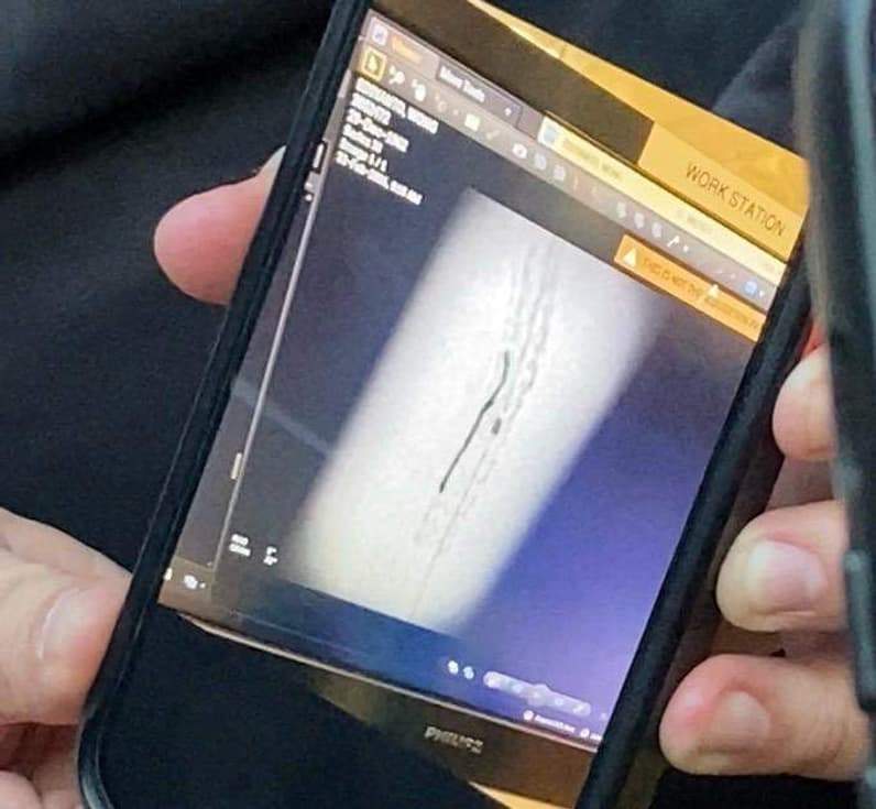 Gambaran guidewire yang tertinggal di jantung pasien usai operasi pemasangan ring jantung di RSUD AWS. (Foto: Tri/Pusaranmedia.com)